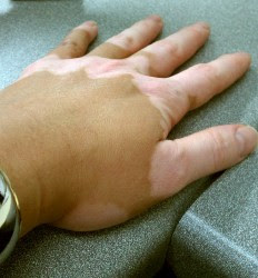 Vitiligo cNew treatment Vitiligo | Beyond Vitiligo | Vitiligo support group in SAauses | Beyond Vitiligo | Support group in SA