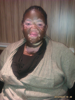 Conquering Vitiligo | Beyond Vitiligo | Vitiligo support group in South Africa