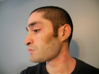 Pigment Restoration | Beyond Vitiligo | Vitiligo support group in SA