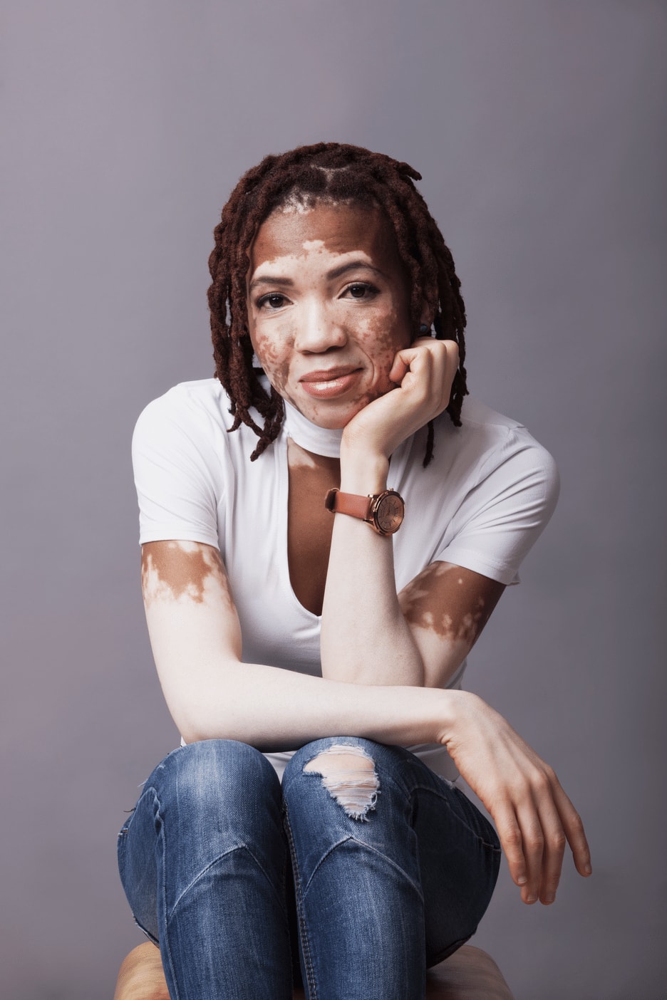 Gaone Tlhong | Beyond Vitiligo | Support group in South Africa