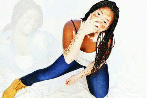 New technology of vitiligo treatment