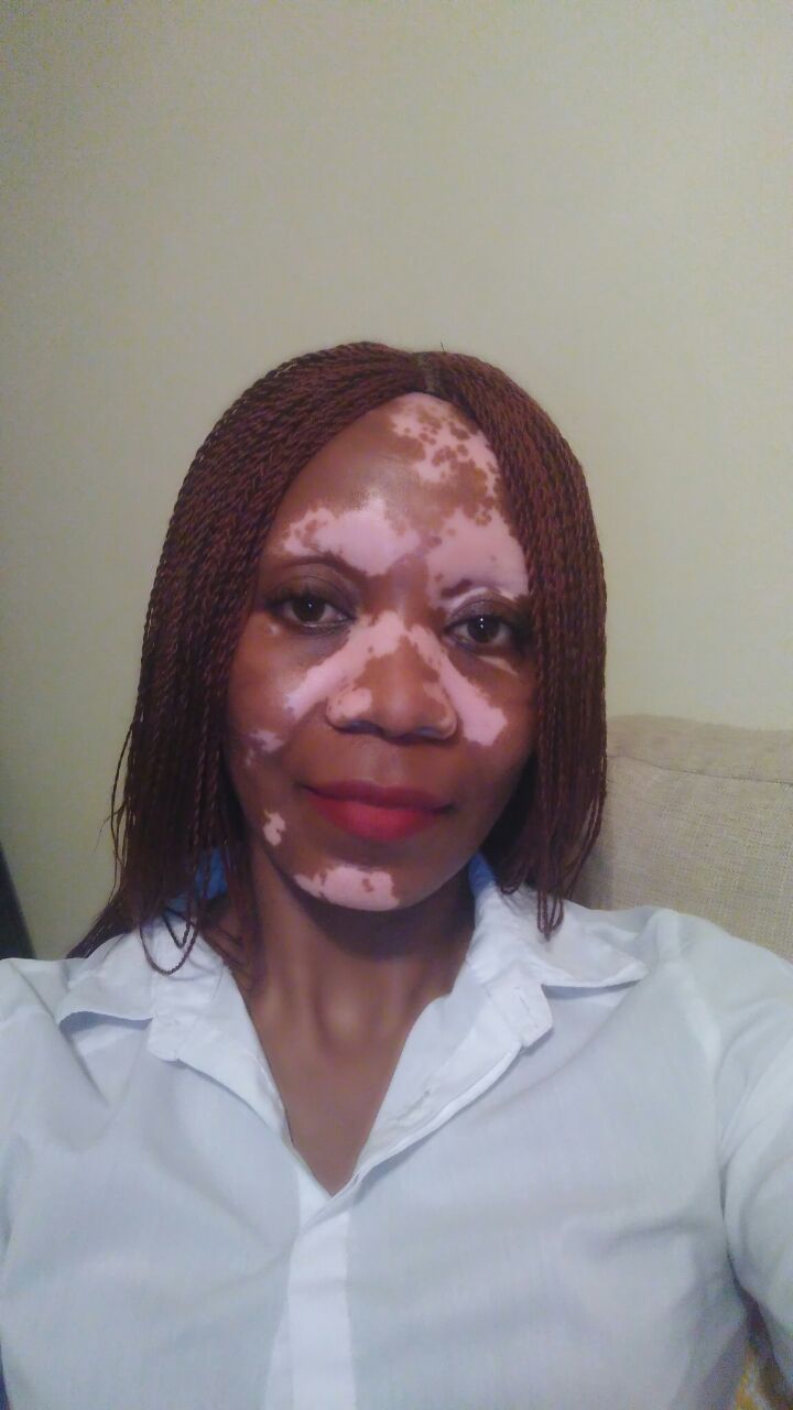Vitiligo self-love | Beyond Vitiligo | Vitiligo in South Africa