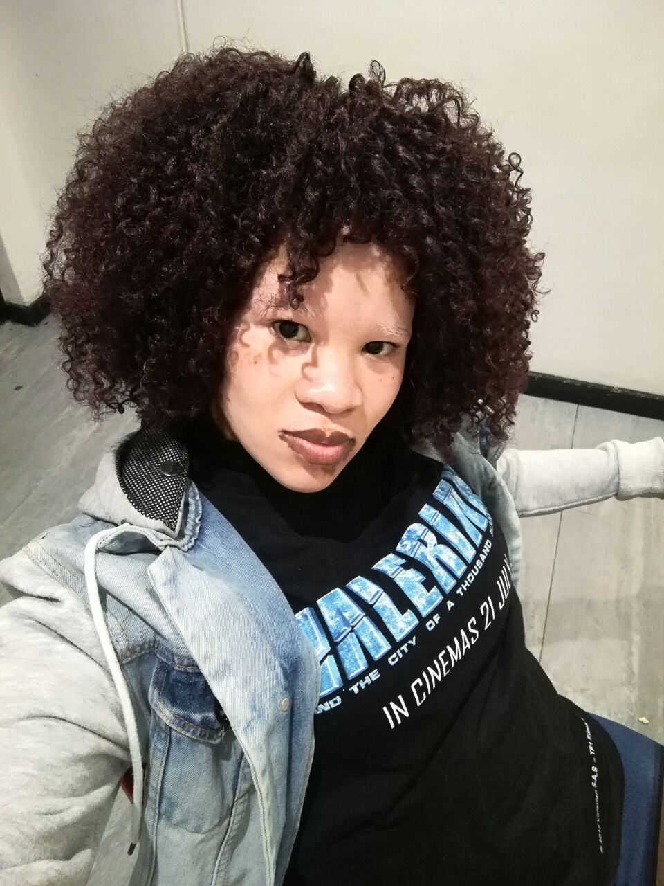 Is there a cure for vitiligo | Beyond Vitiligo | Vitiligo Support group in SA