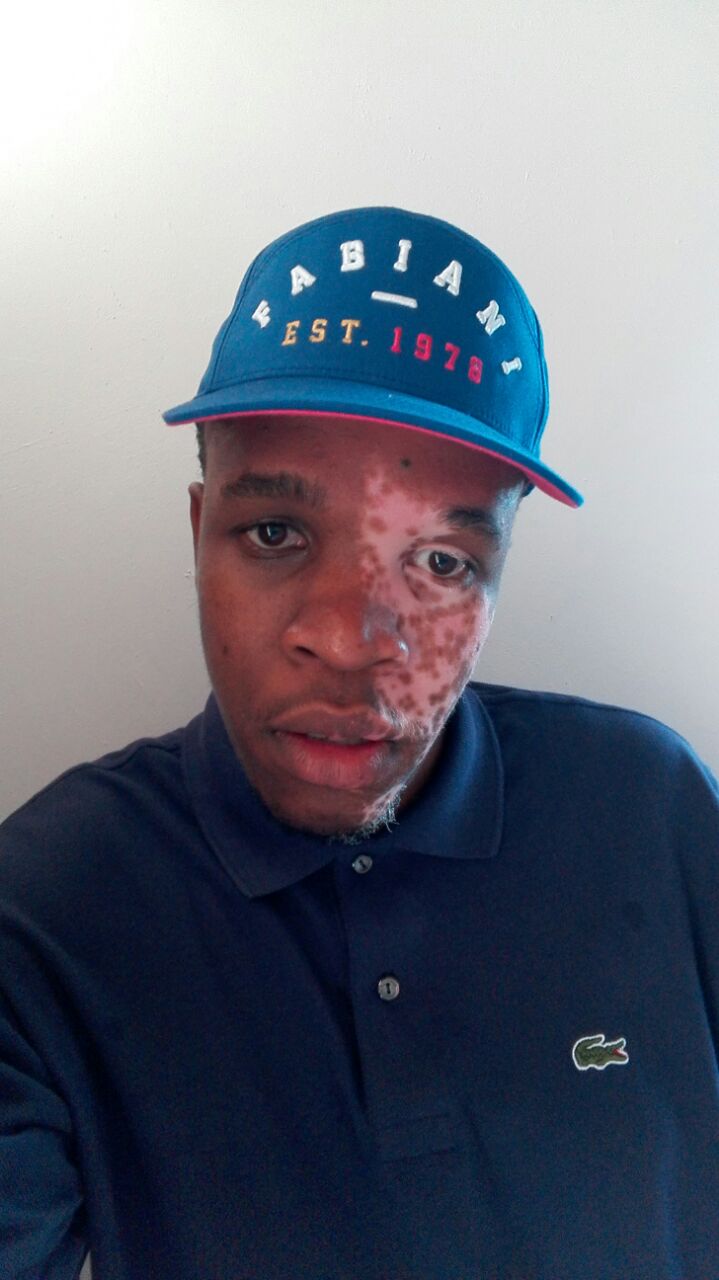 Treatment for vitiligo | Beyond Vitiligo | Vitiligo support group in South Africa