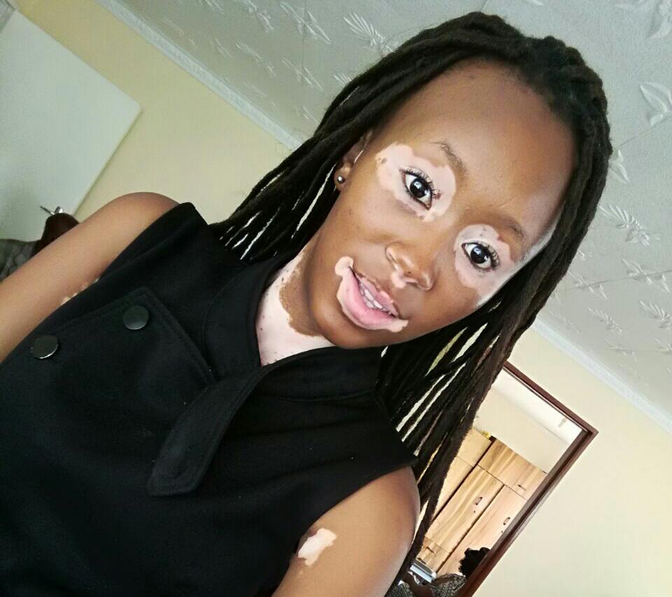 Nobuntu Morake | Beyond Vitiligo | Vitiligo in South Africa