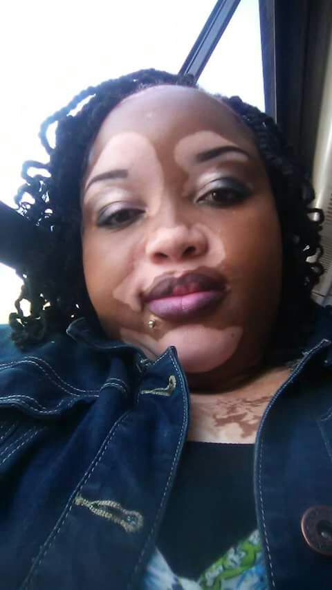 Vitiligo Support group in SA | Beyond Vitiligo | Skin Pigment disease