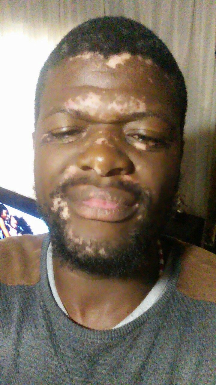 Vitiligo diet | Treatfment for Vitiligo | Suport group in South Africa