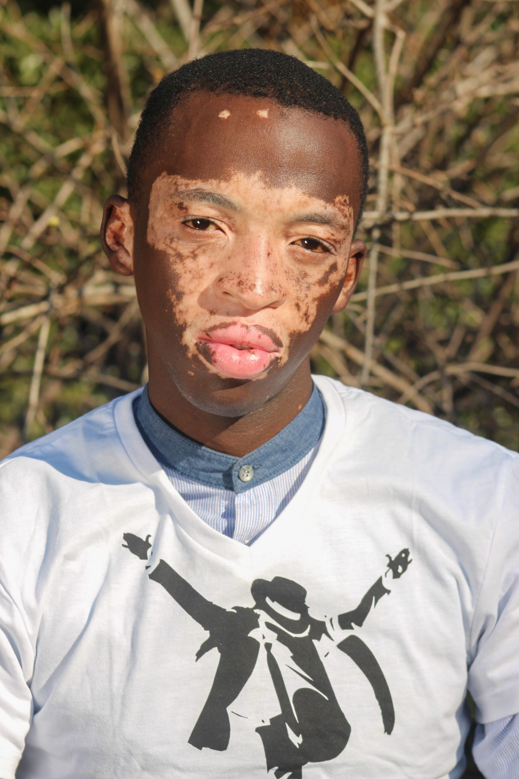First man to have vitiligo | Vitiligo in South Africa | Beyond Vitiligo