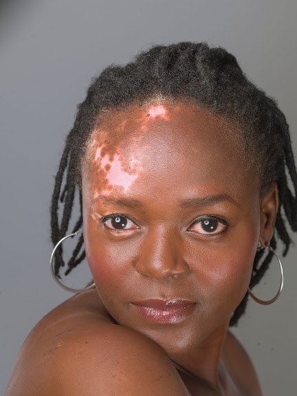 Pigmentation loss | Beyond Vitiligo | About Vitiligo in South Africa