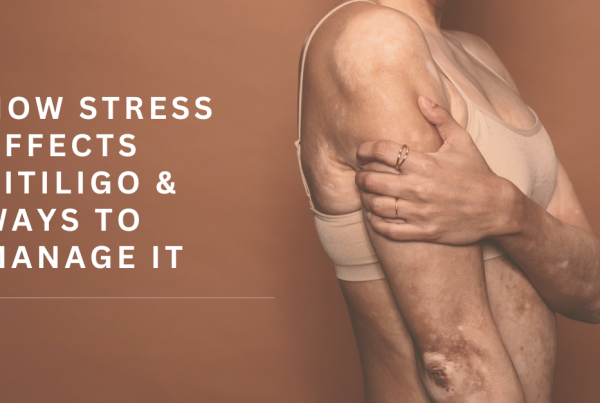 How Stress Affects Vitiligo & Ways to Manage It